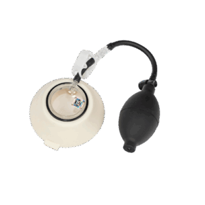 Pectus Excavatum (Thorax en Entonnoir)